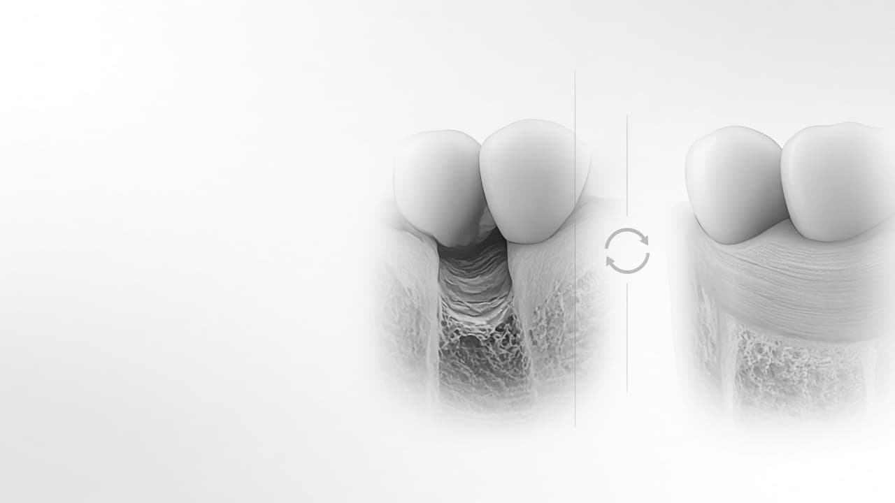 ¿La periodontitis se cura o es para toda la vida?